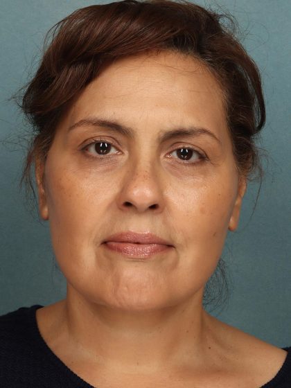 Facelift Before & After Patient #10623
