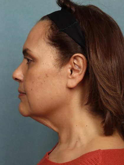 Facelift Before & After Patient #10623
