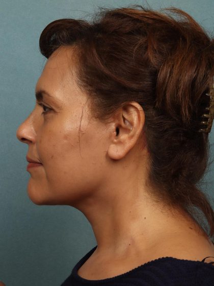 Facelift Before & After Patient #10623