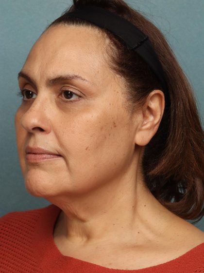 Facelift Before & After Patient #10623