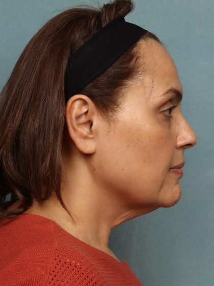 Facelift Before & After Patient #10623
