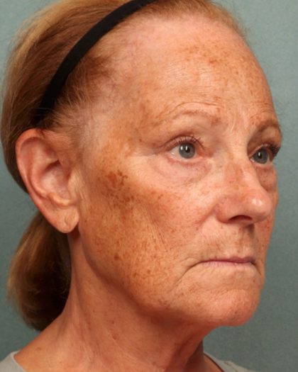 Blepharoplasty Before & After Patient #10585