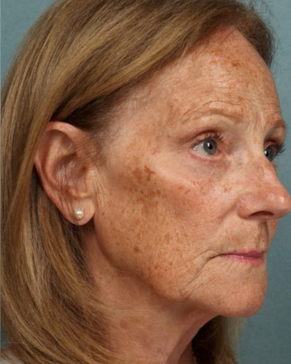 Blepharoplasty Before & After Patient #10585