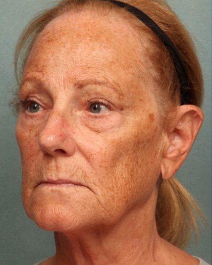 Blepharoplasty Before & After Patient #10585