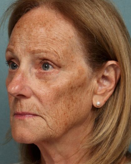 Blepharoplasty Before & After Patient #10585
