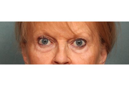 Eye Lift Before & After Patient #10652