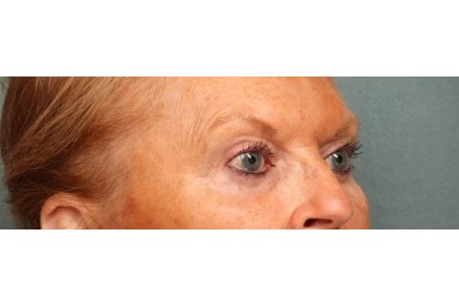 Eye Lift Before & After Patient #10652