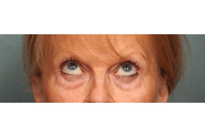 Eye Lift Before & After Patient #10652