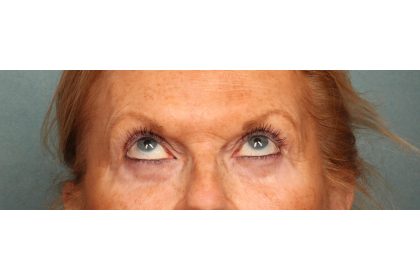 Eye Lift Before & After Patient #10652