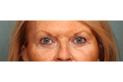 Eye Lift Before & After Patient #10652