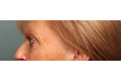 Eye Lift Before & After Patient #10652