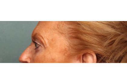 Eye Lift Before & After Patient #10652