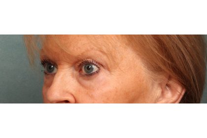 Eye Lift Before & After Patient #10652
