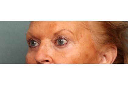 Eye Lift Before & After Patient #10652