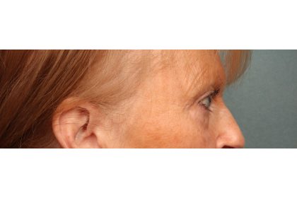 Eye Lift Before & After Patient #10652