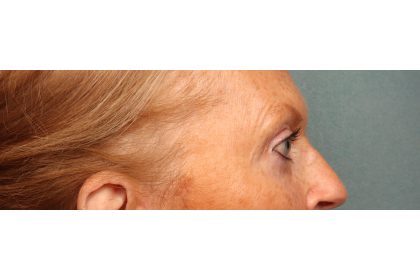 Eye Lift Before & After Patient #10652