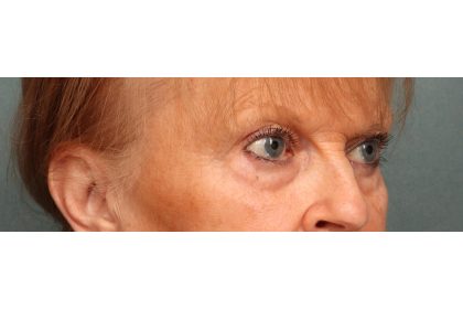 Eye Lift Before & After Patient #10652