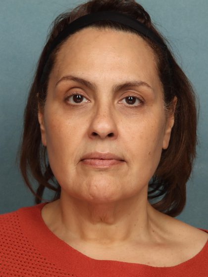 Facelift Before & After Patient #10594
