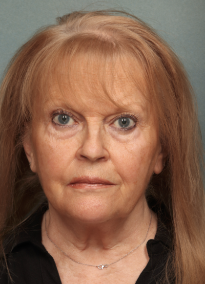 Facelift Before & After Patient #10651