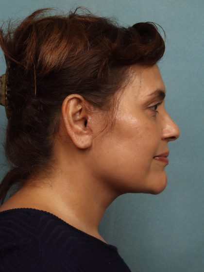 Facelift Before & After Patient #10594