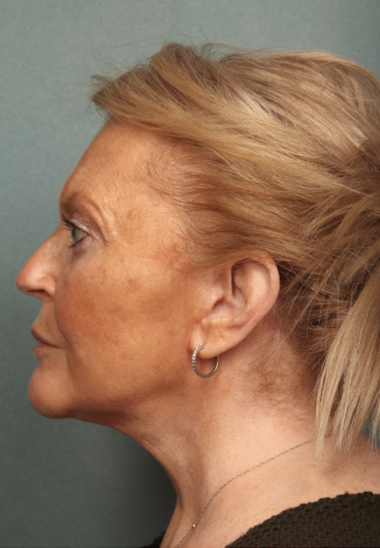 Facelift Before & After Patient #10651