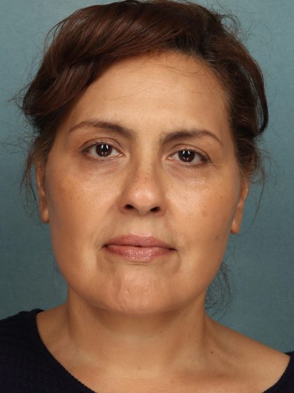 Facelift Before & After Patient #10594