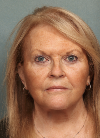 Facelift Before & After Patient #10651