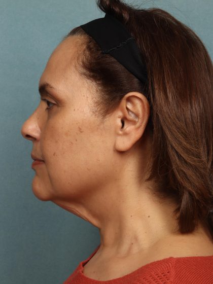 Facelift Before & After Patient #10594