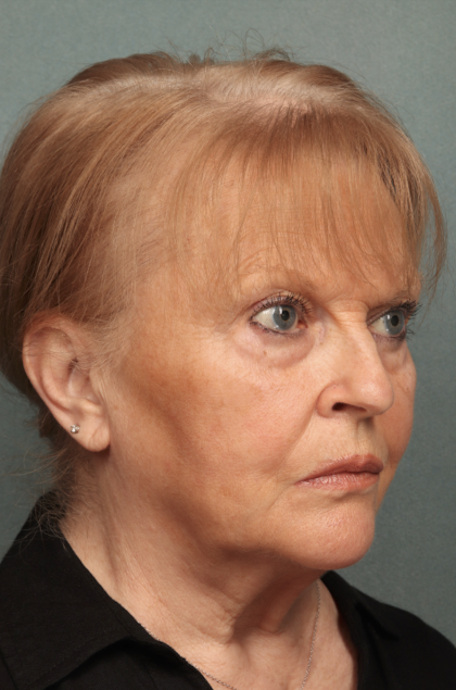 Facelift Before & After Patient #10651