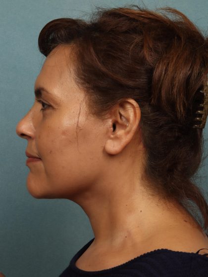 Facelift Before & After Patient #10594