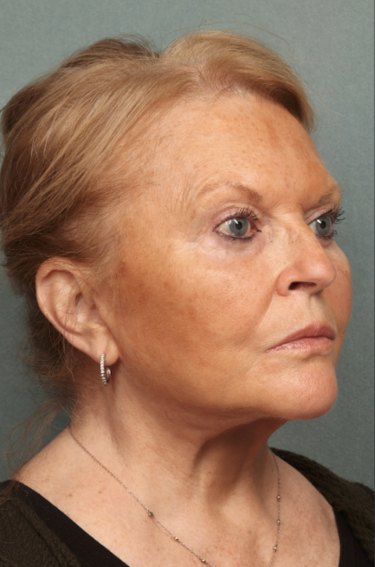Facelift Before & After Patient #10651