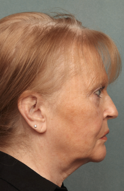 Facelift Before & After Patient #10651