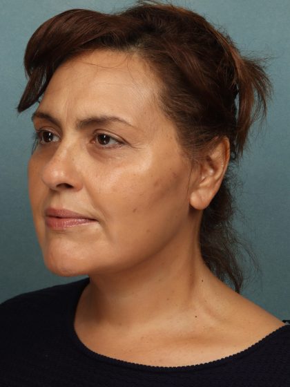 Facelift Before & After Patient #10594