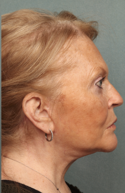 Facelift Before & After Patient #10651