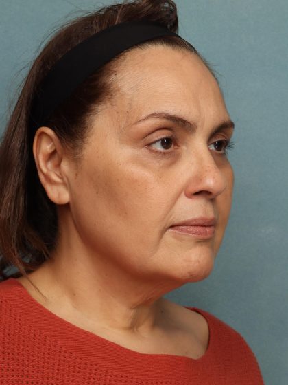 Facelift Before & After Patient #10594