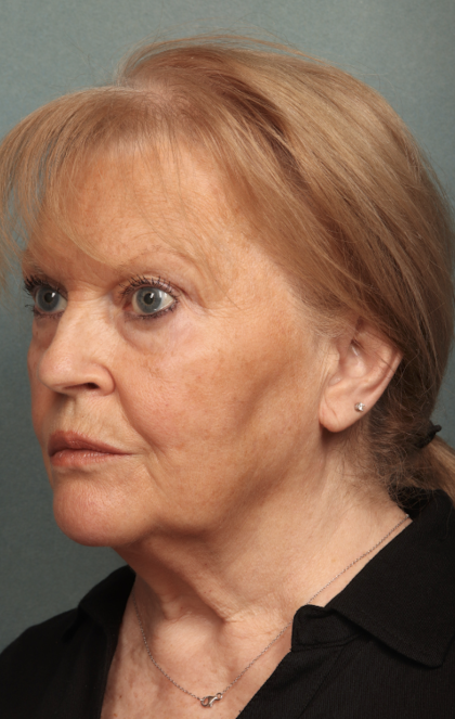 Facelift Before & After Patient #10651