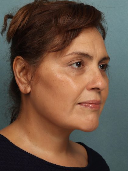 Facelift Before & After Patient #10594