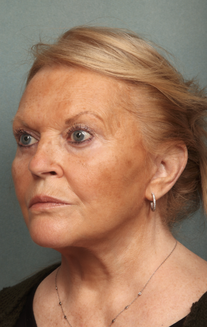 Facelift Before & After Patient #10651