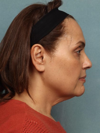Facelift Before & After Patient #10594