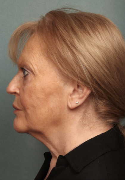 Facelift Before & After Patient #10651