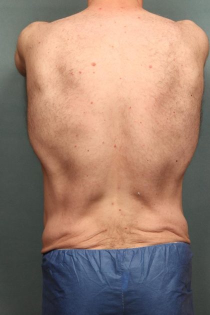 Body Lift Before & After Patient #10687