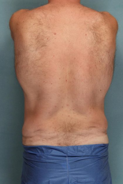 Body Lift Before & After Patient #10687