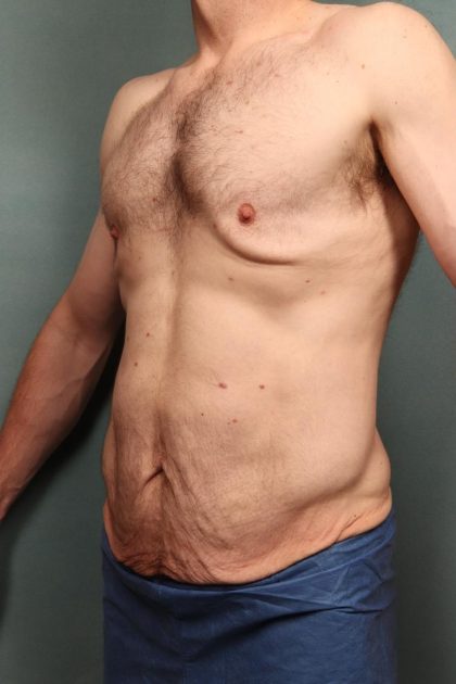 Body Lift Before & After Patient #10687