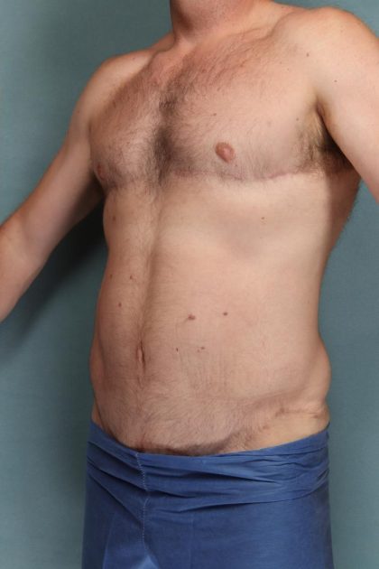 Body Lift Before & After Patient #10687