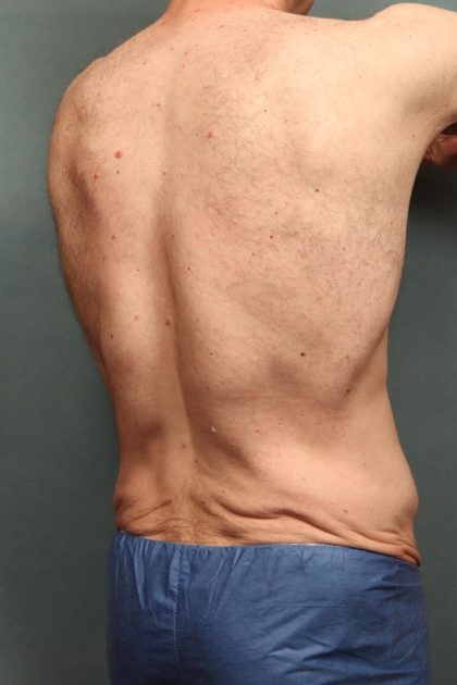 Body Lift Before & After Patient #10687
