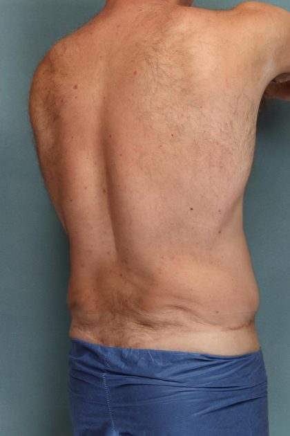 Body Lift Before & After Patient #10687