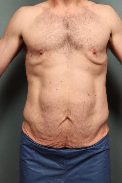 Body Lift Before & After Patient #10687