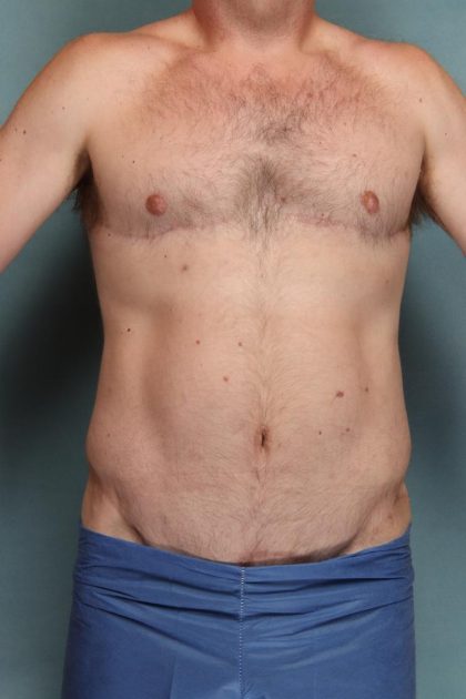 Body Lift Before & After Patient #10687
