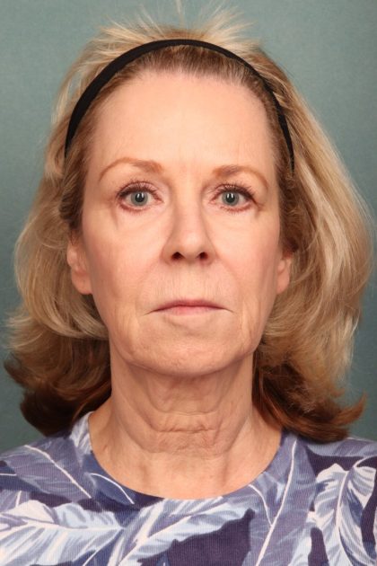 Chemical Peel Before & After Patient #10711