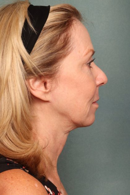 Chemical Peel Before & After Patient #10711